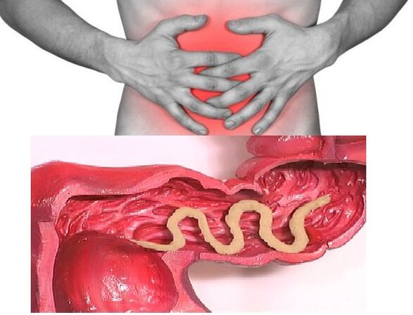 Parasitos no intestino humano